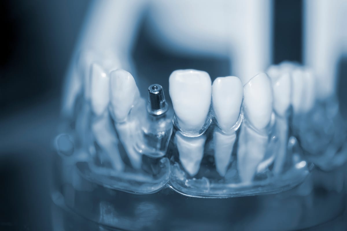 A close-up shot of a dentist consulting with a patient about dental implant options, with a brochure in the background titled "Understanding Dental Implant Costs."
